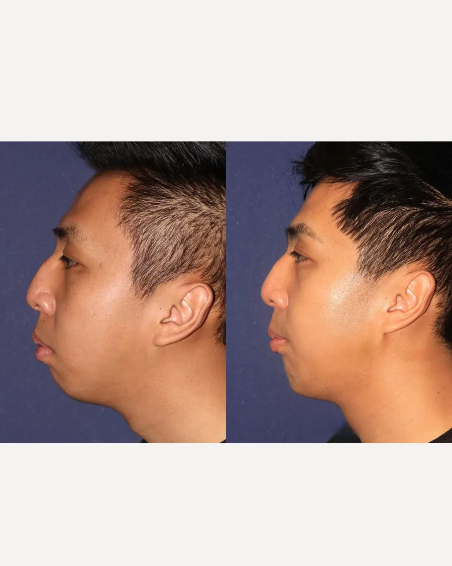 Advanced Facial Sculpting with Jawline Contouring at Cinch Clinics